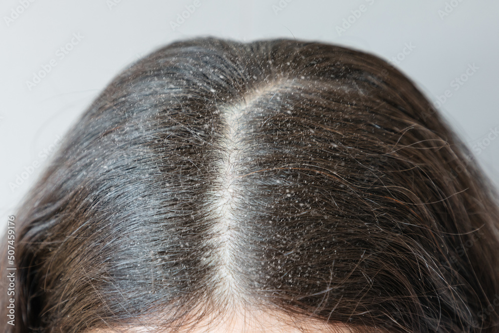 Close Up Of The Parting Of Brunette Hair On The Head Covered With Dandruff The Concept Of 