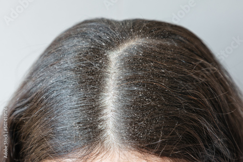 Fényképezés Close-up of the parting of brunette hair on the head covered with dandruff