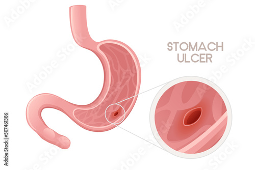 Human Stomach ulcer cartoon design human anatomy organ vector illustration on white background