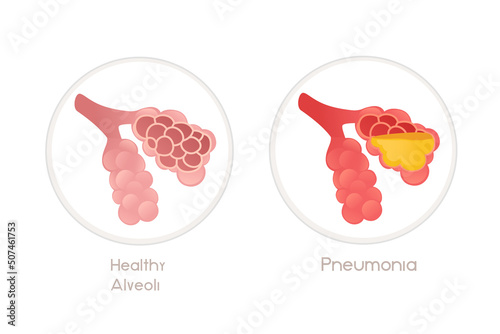 Human alveoli with pneumonia cartoon design human anatomy organ vector illustration on white background