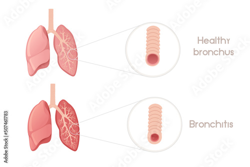 Human bronchi with bronchitis cartoon design human anatomy organ vector illustration on white background