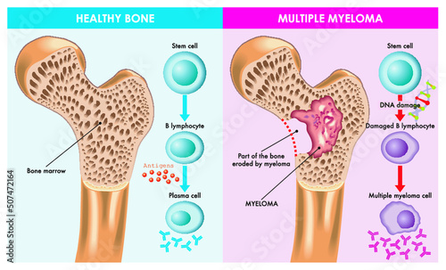 Medical illustration shows the difference between healthy bone and one that is eroded by multiple myeloma, which is caused by damaged DNA.