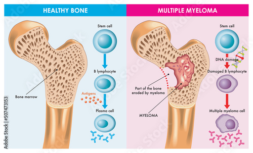 Medical illustration shows the difference between healthy bone and one that is eroded by multiple myeloma, which is caused by damaged DNA.
