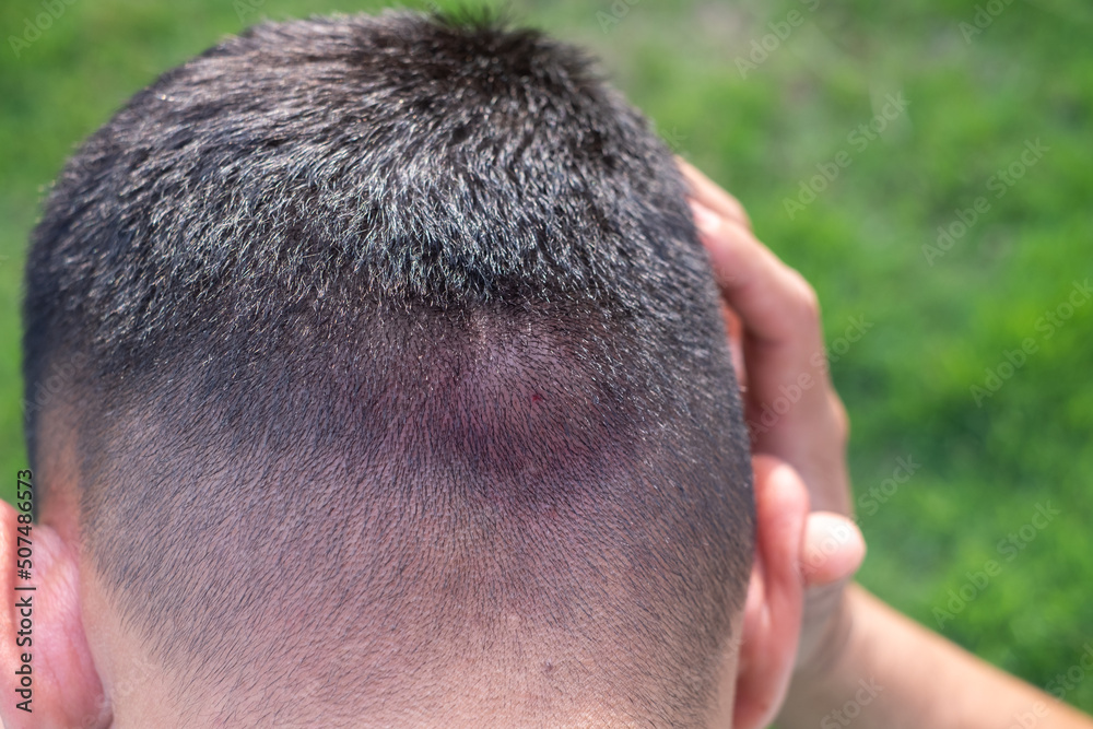 Obraz premium man is holding his head in pain from a hornet or bee sting.