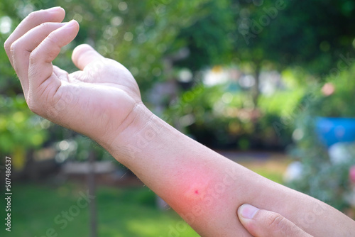 Fotografie Swollen arms due to mosquito bites, poisonous animals, plague in the rainy seaso