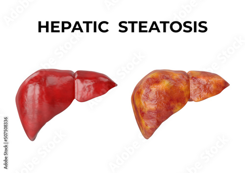 Hepatic steatosis is a disorder characterized by the accumulation of fat inside the liver cells