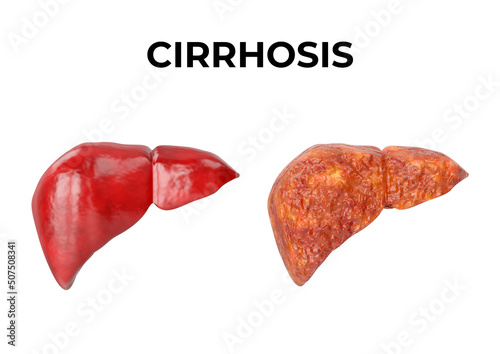 Liver cirrhosis is a chronic inflammation of the liver, a fibrous tissue replaces normal liver tissue, blocking blood flow photo