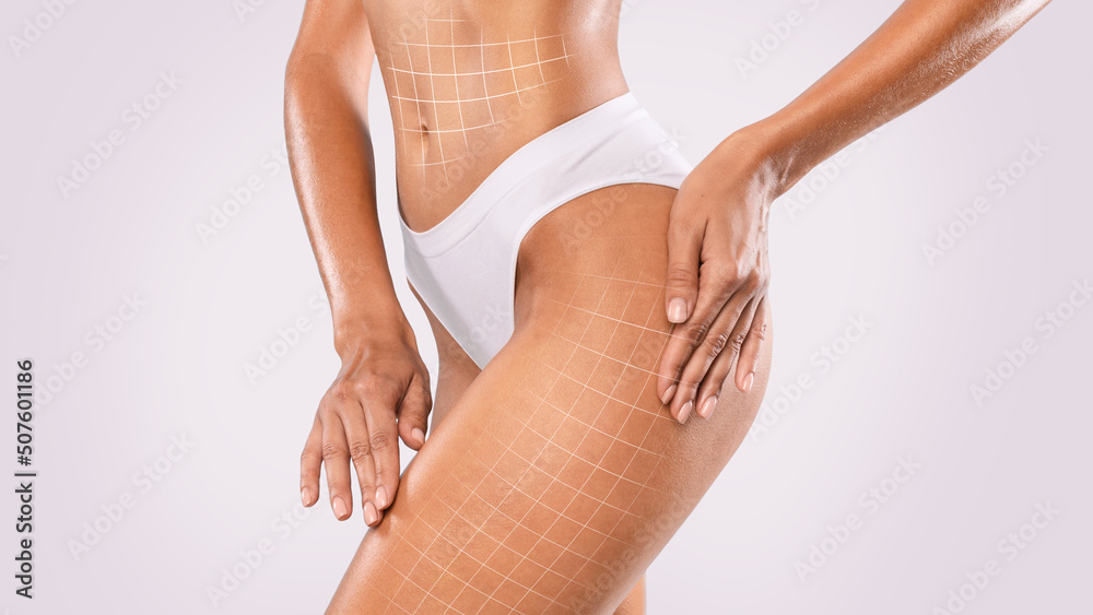 Anti-Cellulite Treatment. Lifting Up Lines Drawn On Perfect Female