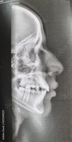 x ray of human skull
Radiographie tete nez