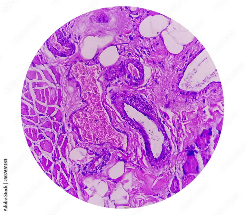 Microscopic view of histological tissue study showing Rhabdomyoma. Microscopic view of histological tissue study showing Rhabdomyoma.