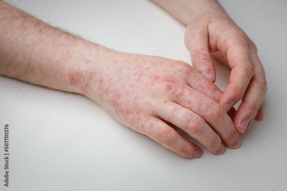 Allergy, red itchy rash on male hands on white table. Dermatological problem, skin symptom of patient. Close up shot Allergy, red itchy rash on male hands on white table. Dermatological problem, skin symptom of patient. Close up shot