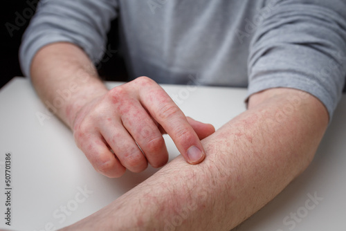 Patient showing red itchy rash on hands and arms. Dermatitis, eczema, dermatological problem, skin treatment and health care
