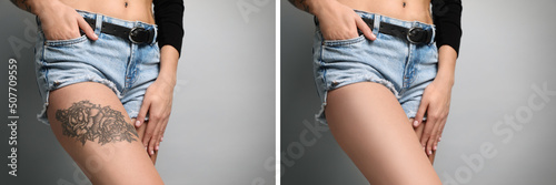Foto Woman before and after laser tattoo removal procedure on light grey background, closeup