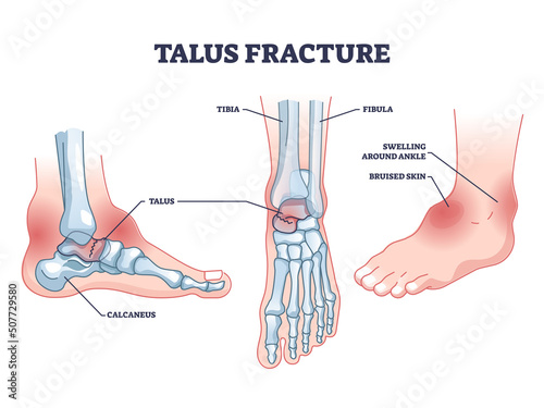 Valokuva Talus fracture as broken leg with swelling ankle symptom outline diagram