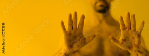 Male hands affected by blistering rash because of monkeypox or other viral infection on yellow background, wide banner.