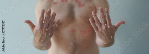 Fotografija Male hands affected by blistering rash because of monkeypox or other viral infec