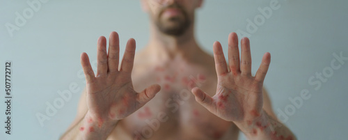 Canvas Print Male hands affected by blistering rash because of monkeypox or other viral infec