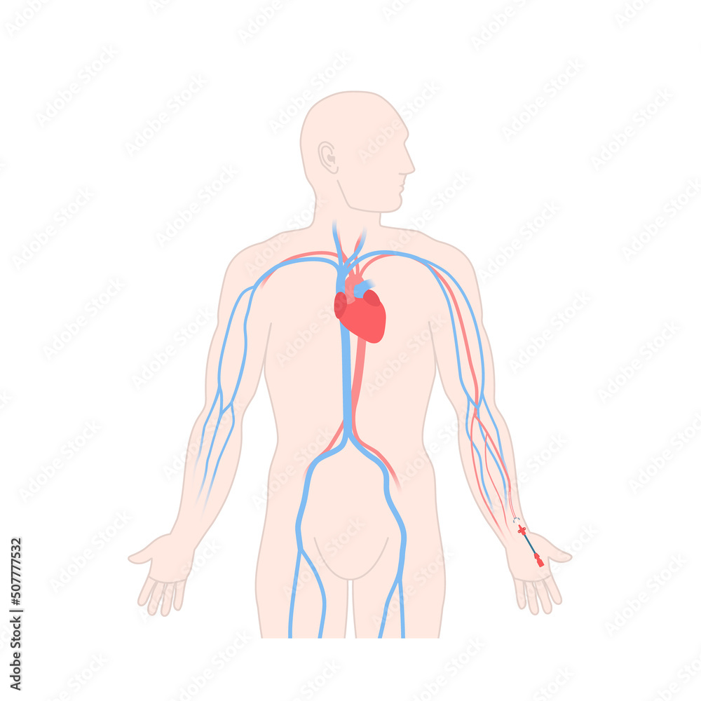 Arterial line catheter placed in the radial artery on the male wrist ...