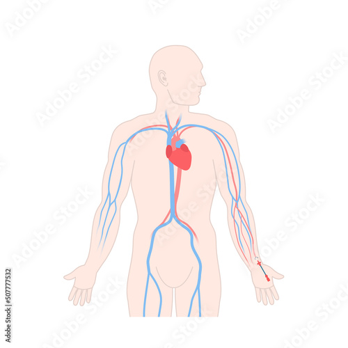 Arterial line catheter placed in the radial artery on the male wrist. Critical care art line for arterial blood gas analysis and monitoring pressure. Medical vector illustration.