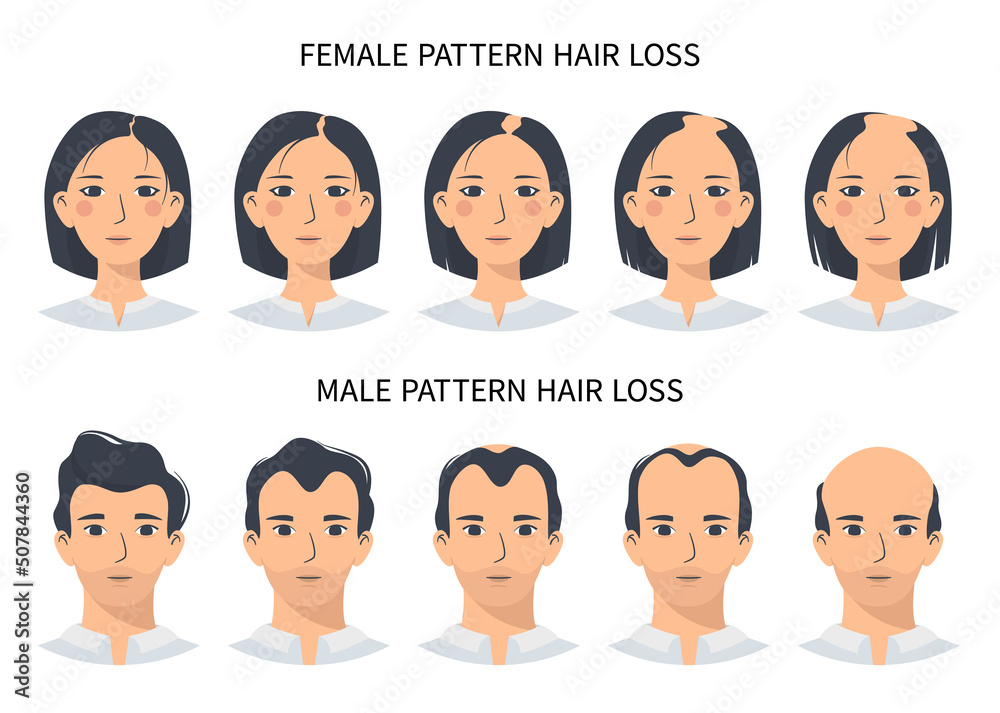 Hair loss stages, androgenetic alopecia male and female pattern. Steps of  baldness vector infographic in a flat style with a man and a woman.  Changing the hairline on the scalp Stock Vector |