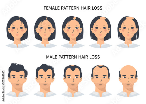 Hair loss stages, androgenetic alopecia male and female pattern. Steps of baldness vector infographic in a flat style with a man and a woman. Changing the hairline on the scalp
