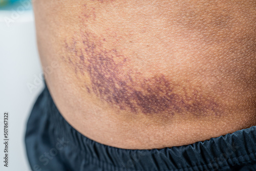 Asian woman dark bruise on the buttocks from a slip accident in the bathroom.