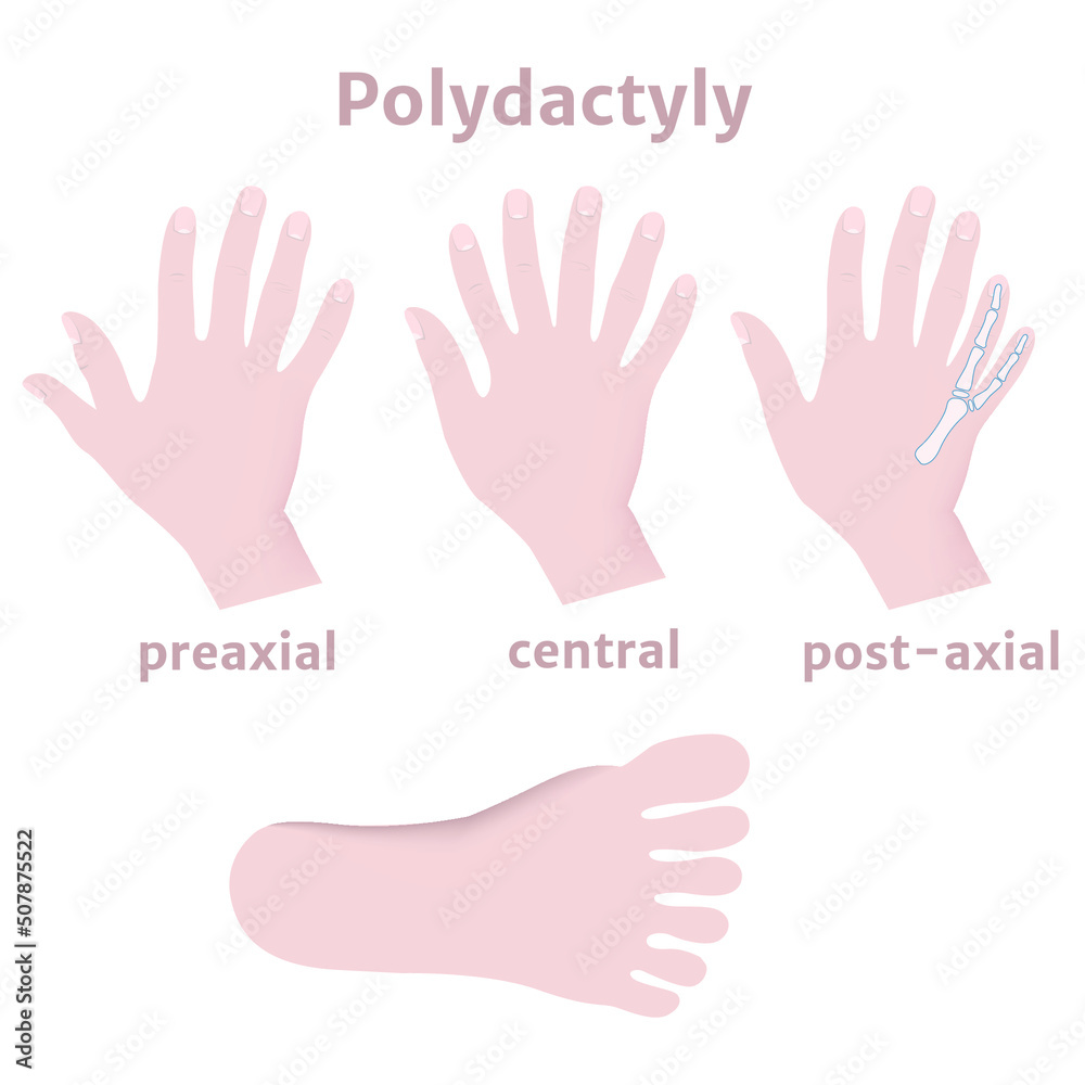 Obraz premium Polydictal hands and feet. Multi-fingering. Medical poster. Vector illustration