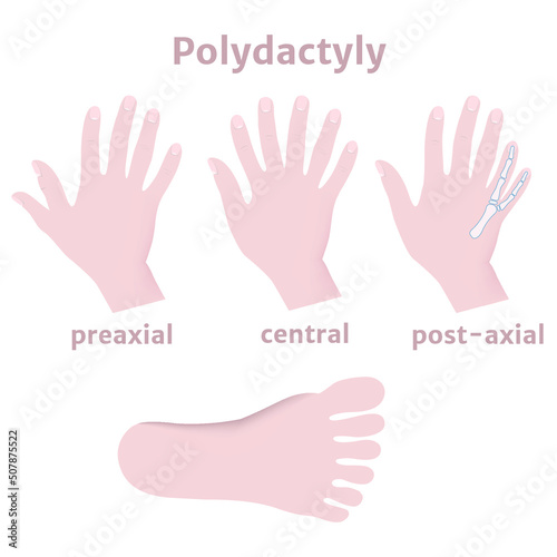 Fototapeta Naklejka Na Ścianę i Meble -  Polydictal hands and feet. Multi-fingering. Medical poster. Vector illustration