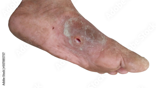 Diabetes foot Infected wound of medical dressing wound infection treatment patient diabetes of leg and blood tissue healing skin on bed hospital. White isolate selective focus.