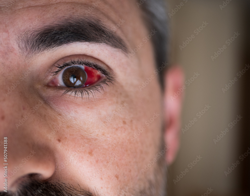 Subconjunctival Hemorrhage On Man Eye Bloody Eye Broken Blood Vessel 