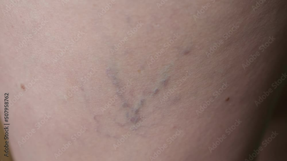 Enlarged varicose veins on old woman leg. Restricted blood flow of aged person. Purple varicose veins twists around elderly lady leg extreme closeup Enlarged varicose veins on old woman leg. Restricted blood flow of aged person. Purple varicose veins twists around elderly lady leg extreme closeup