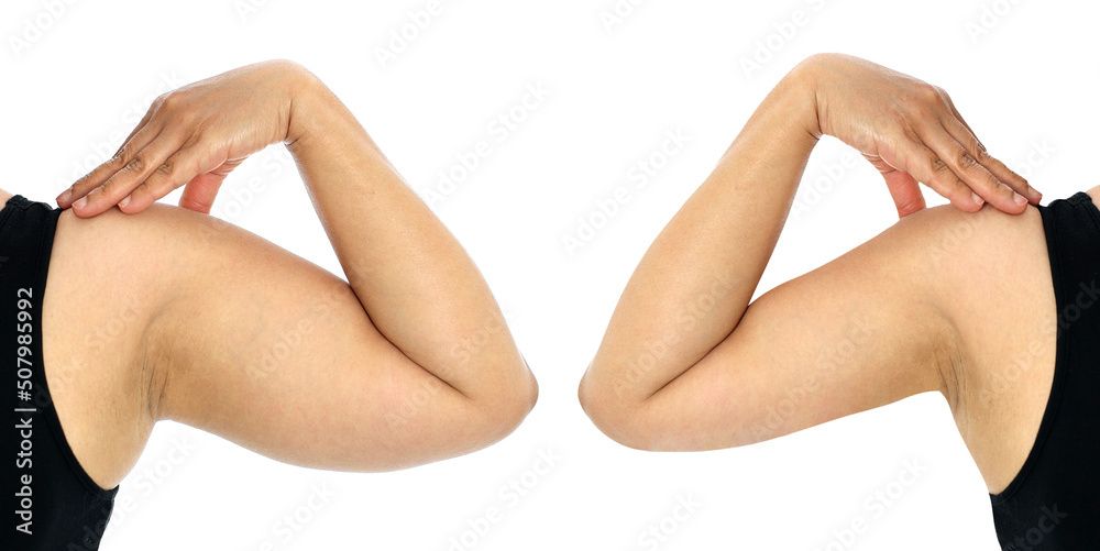 Comparison female arm fat and slimming size before and after losing