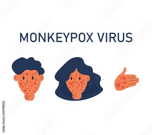 Monkeypox virus zoonotic viral disease that can infect human, nonhuman primates. Monkey pox. Vector illustration