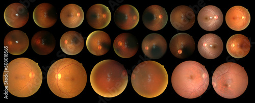 SET of Photo Madical Retina Normal isolated on black background.Diabates retinopathy.Human eye anatomy taking images with Mydriatic Retinal cameras.Madical EYE health Concept. photo