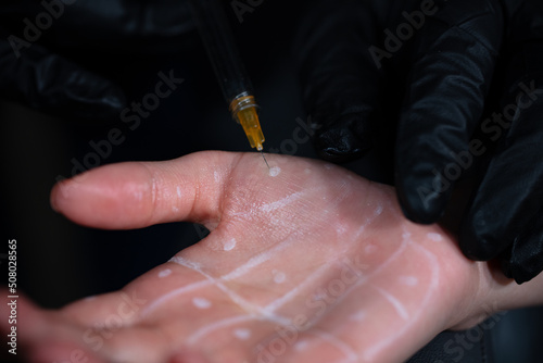 excessive sweating disease. Hyperhidrosis. Women's cosmetology, skin care.
