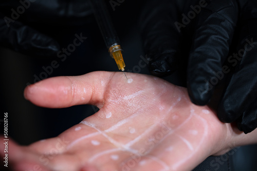 excessive sweating disease. Hyperhidrosis. Women's cosmetology, skin care.
