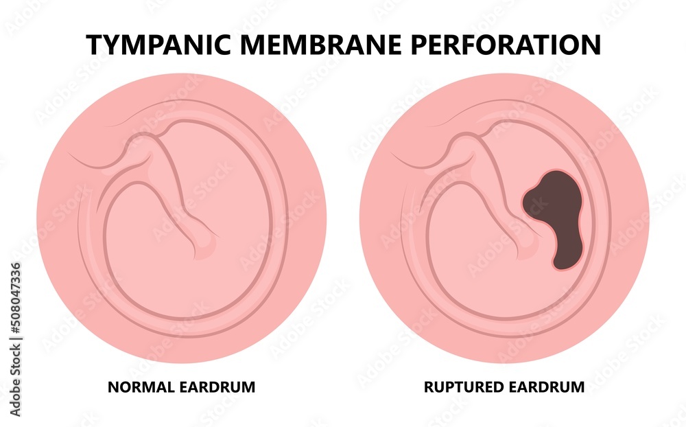 Perforated eardrum tube surgical drain Otitis media ear wax Hole repair