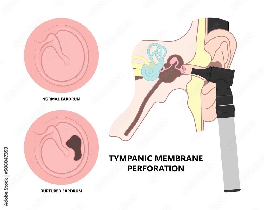 Perforated eardrum tube surgical drain Otitis media ear wax Hole repair
