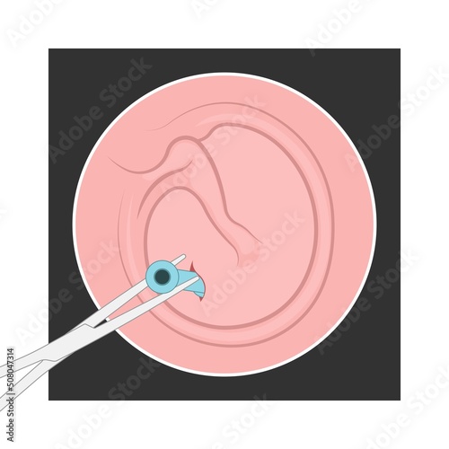 Perforated eardrum tube surgical drain Otitis media ear wax Hole repair sound canal tear pain pus bloody Hearing loss injury Middle fluid water Loud blasts microscopic acute bone cotton swab otoscopic