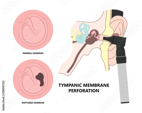 Perforated eardrum tube surgical drain Otitis media ear wax Hole repair sound canal tear pain pus bloody Hearing loss injury Middle fluid water Loud blasts microscopic acute bone cotton swab otoscopic