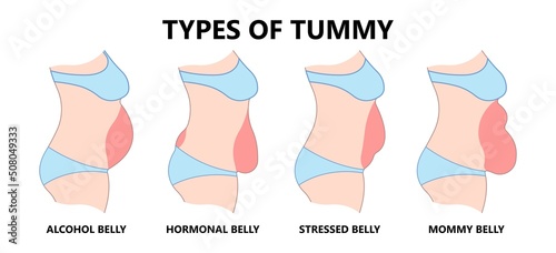 Diastasis Recti six pack separation belly rectus Linea alba abdominal surgical Tummy Tuck skin fat loss c section Ovary Over consuming Bloated Stressed Out childbirth photo