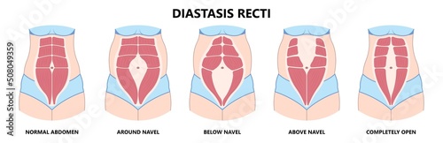 Diastasis Recti six pack separation belly rectus Linea alba abdominal surgical Tummy Tuck skin fat loss c section Ovary Over consuming Bloated Stressed Out childbirth
