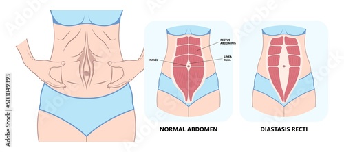 Diastasis Recti six pack separation belly rectus Linea alba abdominal surgical Tummy Tuck skin fat loss c section Ovary Over consuming Bloated Stressed Out childbirth