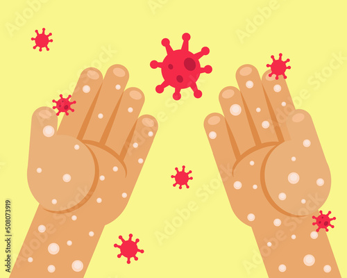 Monkeypox outbreak concept. Hands with virus. Cartoon vector style for your design.