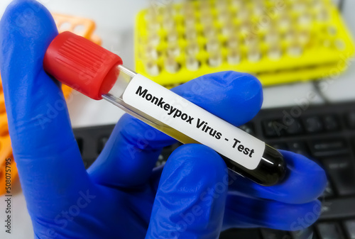 Blood sample for Monkeypox virus test.