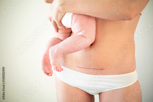 Mom's abdomen after cesarean section. Scar seam. A young mother holds the baby in her arms. Real motherhood. Lifestyle
