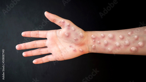 MONKEYPOX. The arm is blistered from monkeypox. Virus, epidemic, disease. Black background. photo