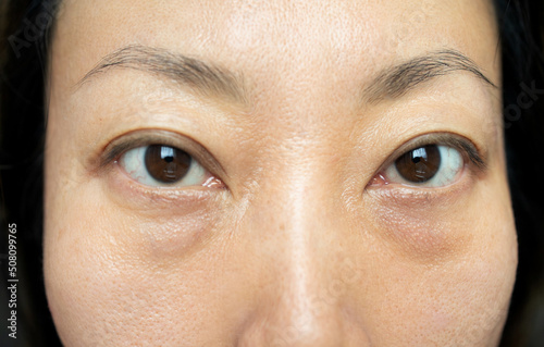 Asian woman have facial wrinkles, large bags under their eyes.