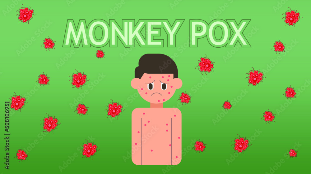 Illustration of monkeypox virus, Vector of a person with monkeypox, Concept of monkeypox, illustration of hives on the skin of monkeypox Illustration of monkeypox virus, Vector of a person with monkeypox, Concept of monkeypox, illustration of hives on the skin of monkeypox