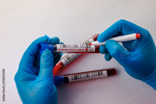 flasks with blood tests for monkey pox virus positive and negative, mpox photo